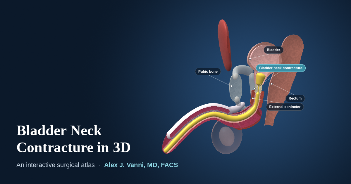 3D cutaway model showing scar narrowing the bladder neck where the bladder joins the urethra after prostatectomy