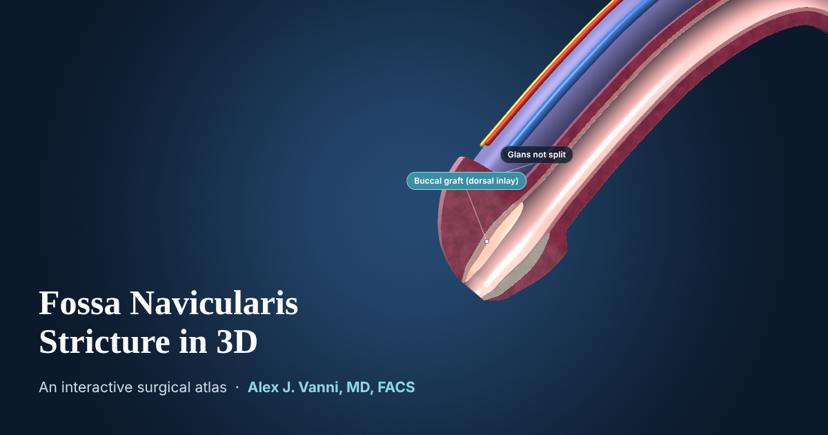 3D cutaway model of the glans showing a stricture of the fossa navicularis just inside the urethral opening