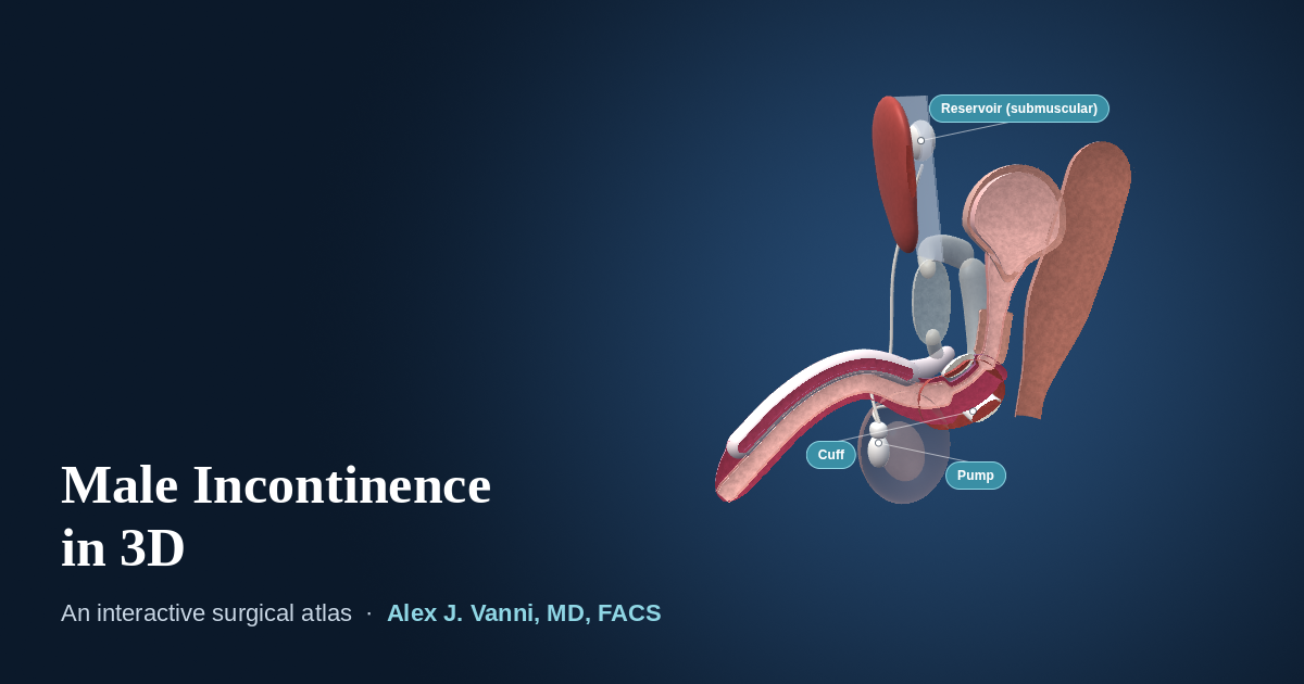 3D model of the male pelvis showing an artificial urinary sphincter cuff around the bulbar urethra with its pump and reservoir