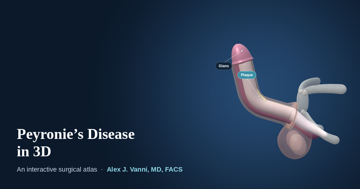 3D model of an erect penis curving upward 60 degrees because of a dorsal Peyronie's plaque