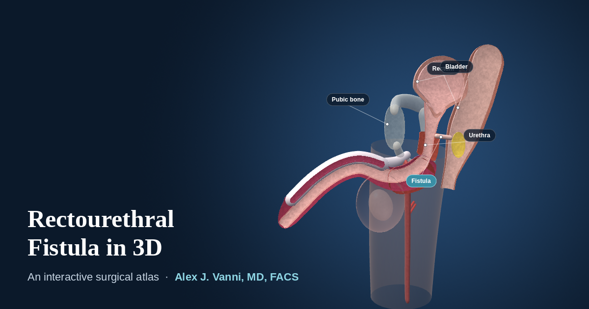 3D cutaway model showing a fistula connecting the urethra to the rectum after prostate cancer treatment