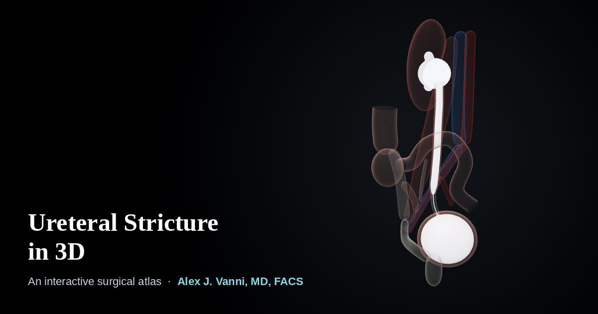 3D model of the right kidney, ureter and bladder showing a narrowing in the lower ureter