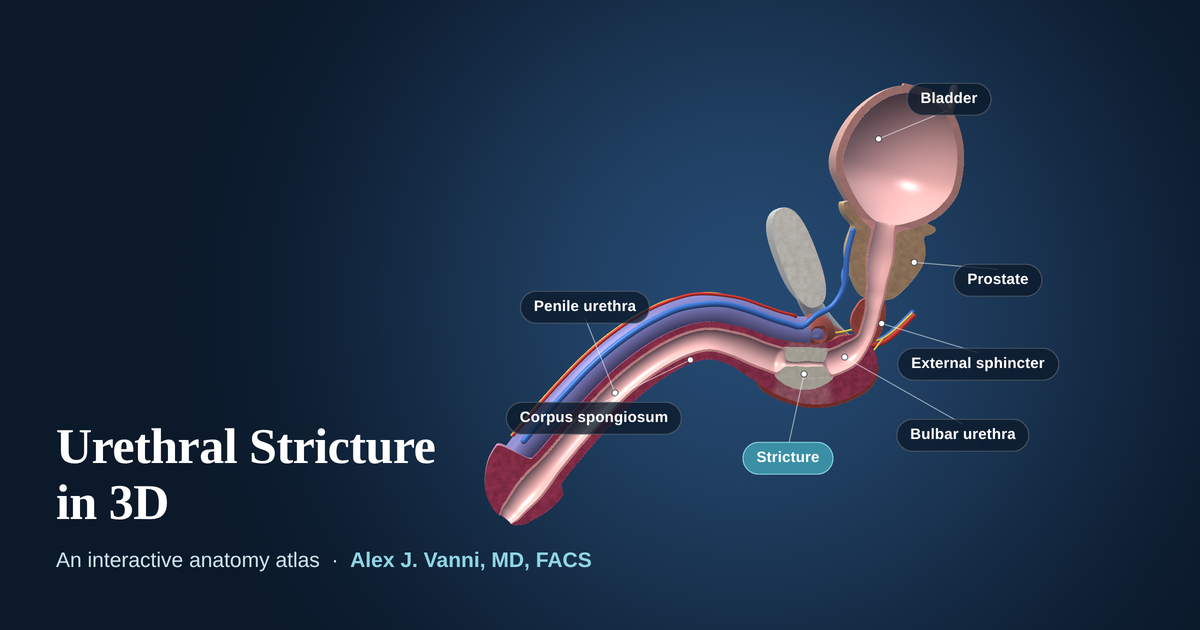 3D cutaway model of the male urethra showing a short stricture in the bulbar urethra